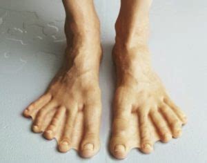 Foot Wiki Foot Problems And Conditions Webbed Toes