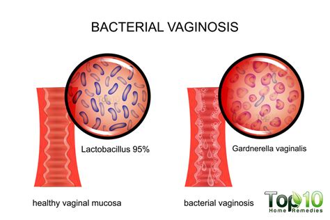 Facts Symptoms Of Bacterial Vaginosis