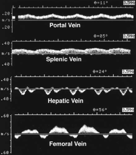 Arterial Waveforms Ultrasound