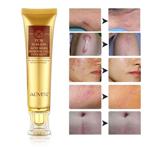 Scar Cream Aliver Strench Mark And Acne Spot Removal Cream For Etsy