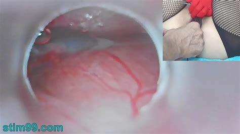 Sex Clip Uncensored Japanese Insemination With Cum Into Uterus And Endoscope Camera By Cervix To