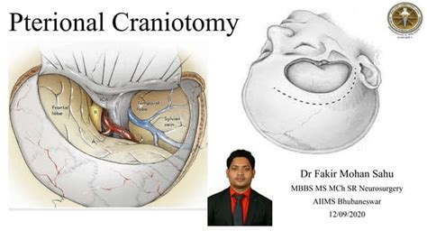 Pterional Craniotomy Ppt