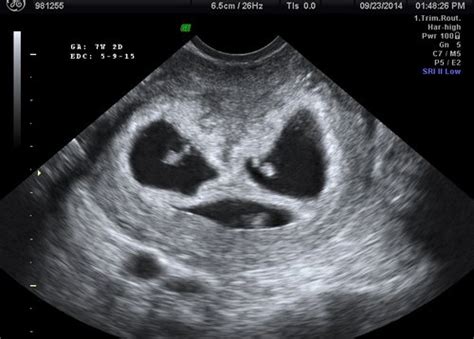 Triplets Pregnancy Ultrasound