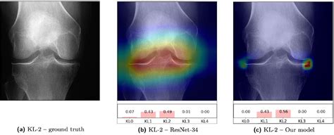 Pdf Automatic Knee Osteoarthritis Diagnosis From Plain Radiographs A