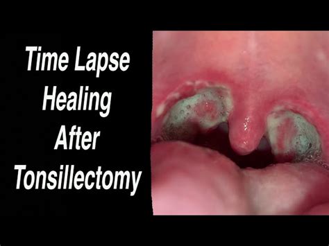 Tonsillectomy And Adenoidectomy Post Op