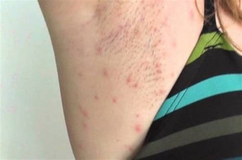 Armpit Bumps Painful Red From Shaving And Treatments Skincarederm