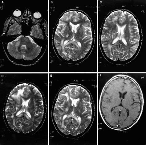 Cerebral Lymphoma Presenting As A Leukoencephalopathy Journal Of