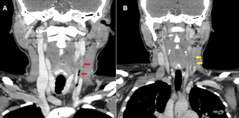 Figure 1 A Ct Soft Tissues Neck With Contrast Demonstrating Filling