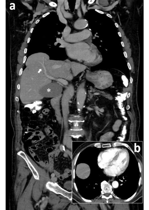 Contrast Enhanced Computed Tomography A Multiplanar Reconstruction