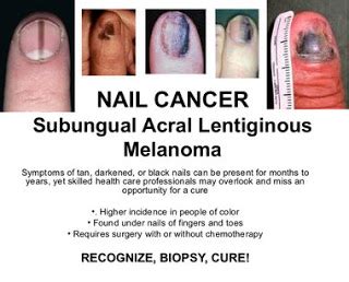 It's commonly found on your face, chest, arms, and hands. "OMG, I Have Cancer. What Do I Do Now????": May is ...