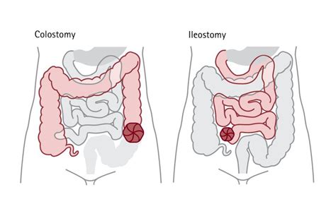 Living With A Stoma