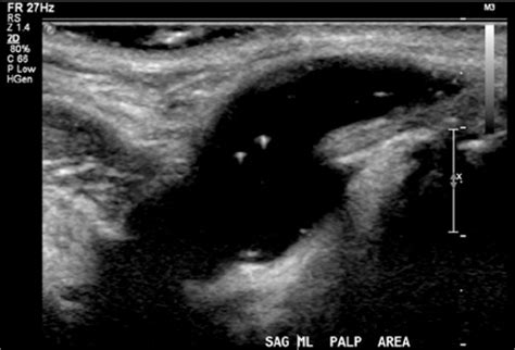 Sonographic Assessment Of A Thyroglossal Duct Cyst Kellie Schmidt 2013