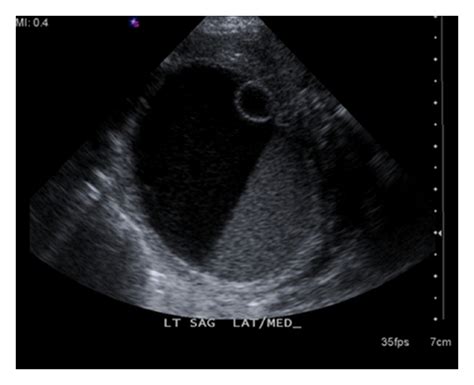 A Sagittal Gray Scale Image Of The Left Ovary Shows A 45 × 56 ×