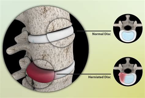 when is surgery needed for a lumbar herniated disc scary symptoms