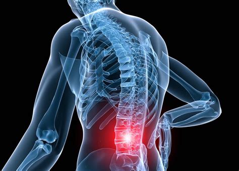 Lumbar muscle strain is caused when muscle fibers are abnormally stretched or torn. Low Back Stiffness - P-DTR® USA