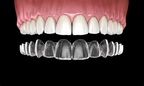 The most advanced clear aligner. The Average Cost of Invisalign | Omega Dental Houston TX