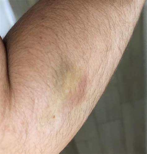 This Bruise On My Arm Looks Like The Flag Of Belgium Flagsirl