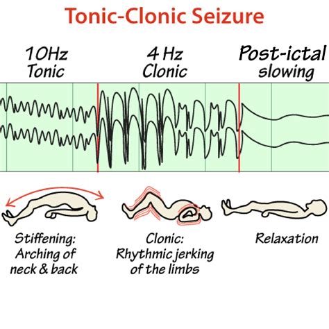 Neurological System Glossary Tonic Clonic Seizure Ditki Medical And Biological Sciences