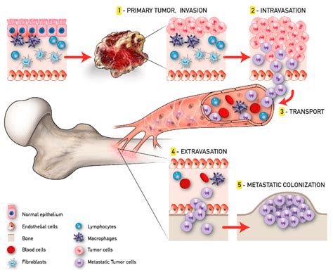 Zahlen Folge Uns Modisch Mechanisms Of Bone Metastases Im Namen Nylon