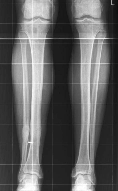 A 38 Year Old Man Sustained A Closed Distal Tibial Metaphyseal Fracture