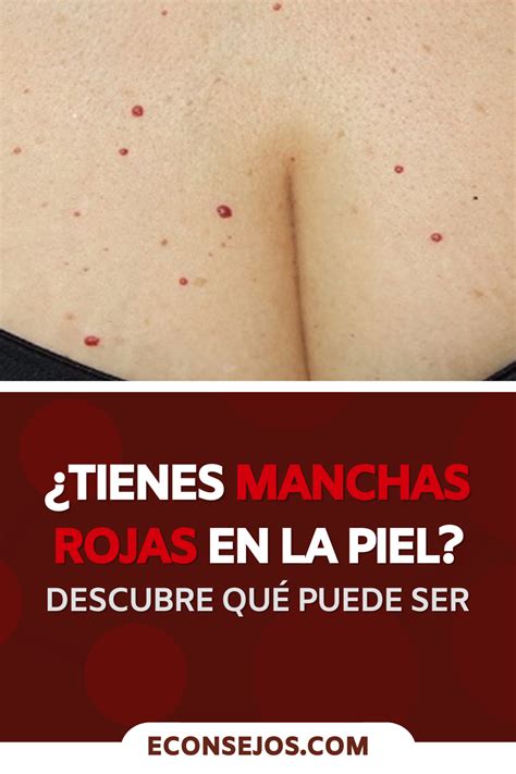 We did not find results for: Tengo muchos puntos rojos en la piel. ¿Debo preocuparme ...