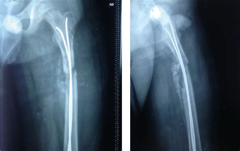 Figure 1 From Treatment Of Aseptic Hypertrophic Nonunion Of The Lower