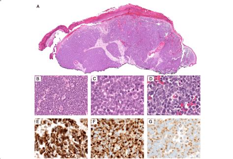 Photomicrographs Of A Typical Merkel Cell Carcinoma At A 4x B 40x And