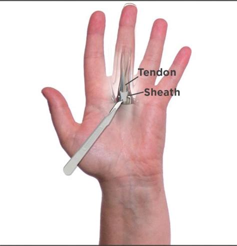 Trigger Finger Release Genesis Orthopedic And Sport Medicine