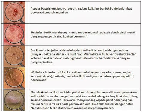 Mengimpikan kulit yang cerah, cantik dan gebu macam snow white gitu. Insulin Punca Jerawat dan Cara Menjaga Kulit Muka Dari ...
