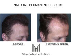 Your physician uses the artas robotic system to digitally scan areas of the scalp, identifying hair in its natural groupings. Silicon Valley Hair Institute, Leaders in San Francisco ...