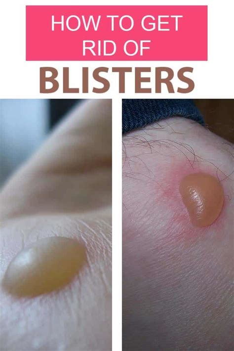 How To Get Rid Of Blisters Fast Home Remedies For Blisters