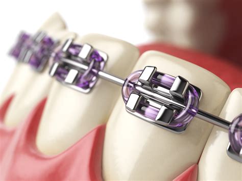 What Are The Most Affordable Braces M Scott Runnels Dmd Pa