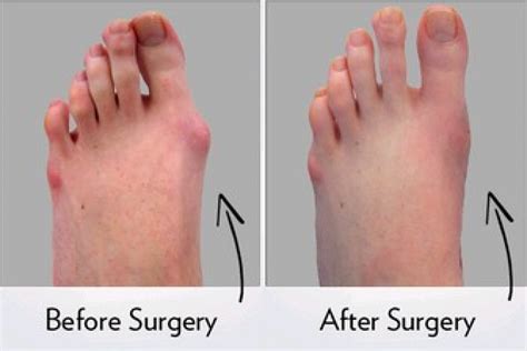 Update More Than Heel Spur Surgery Images Best Esthdonghoadian
