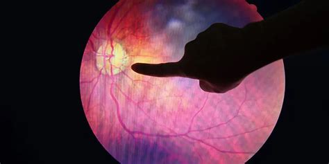 20 Rare Eye Conditions That Ophthalmologists Treat American Academy