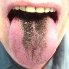Study Medical Photos A Patient With Black Discoloration Of The Tongue