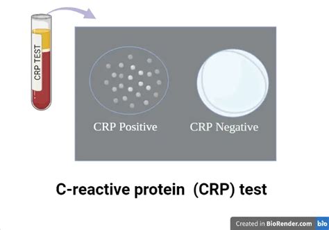 C Reactive Protein Crp Test Principle Procedure Result • Microbe
