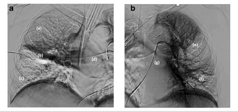 Figure 1 From Percutaneous Closure Of Patent Foramen Ovale In The