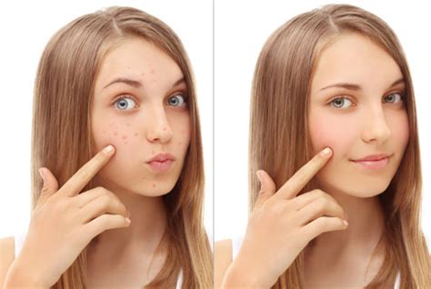 How To Get Rid Of Blind Pimple Treating The Blind Pimples