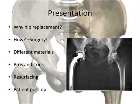 Ppt Hip Arthroplasty Powerpoint Presentation Free Download Id1209827