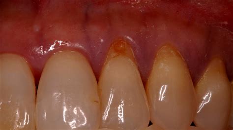 Subepithelial Connective Tissue Graft Connect Choices