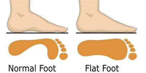 Best Orthotics For Flat Feet Do They Benefit You