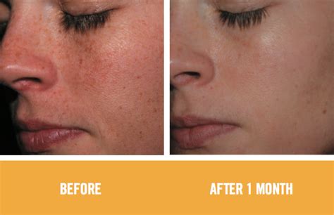 Best Effective Way To Treat Skin Discoloration Laser