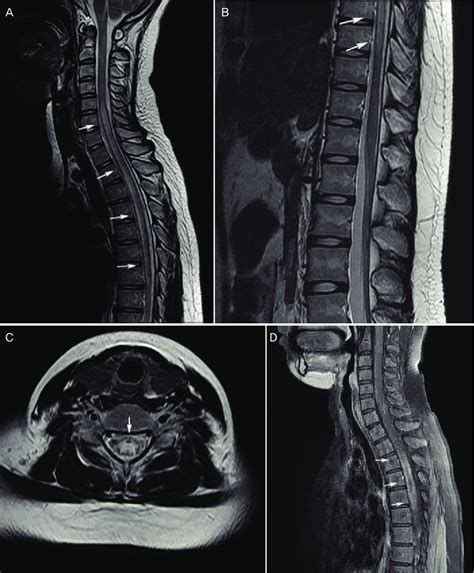 Sagittal Mri Of The Vertebral Column Lateral View Showing The Spinal