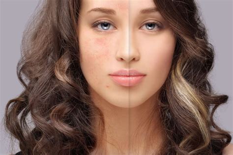 Acne Scar Treatments The 7 Best For You Aesthetics Medspa