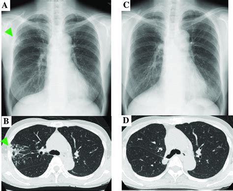 Serial Changes On Chest X Ray And Chest Computed Tomography Findings A