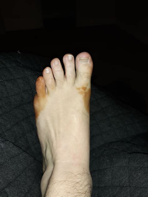 Brown Spots Appeared On My Foot Rmedicaladvice