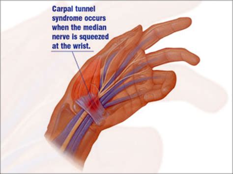 Carpal Tunnel Syndrome Dr Sai Sudarsan A Top Neurosurgeon In Ranchi