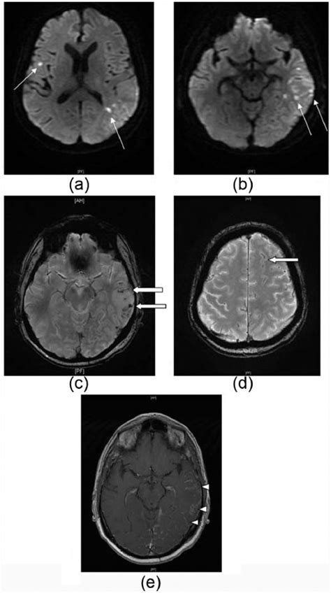 A And B Axial Dwi Mri Performed 9 Days After Figure 1 Revealing