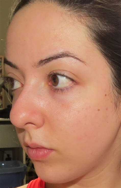 My Skins Journey Week 37 Banish Acne Scars
