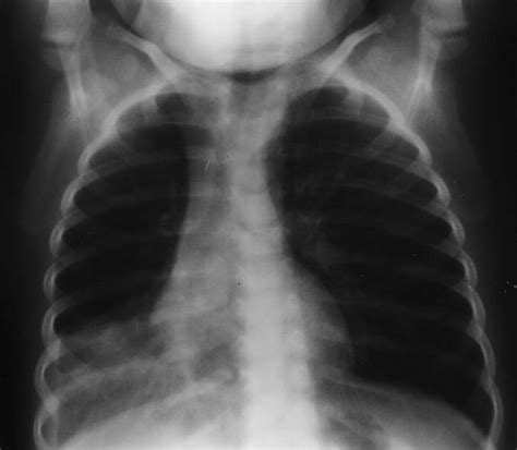 A Chest Radiograph Of Case 1 Showing Right Lower Lobe Opacification
